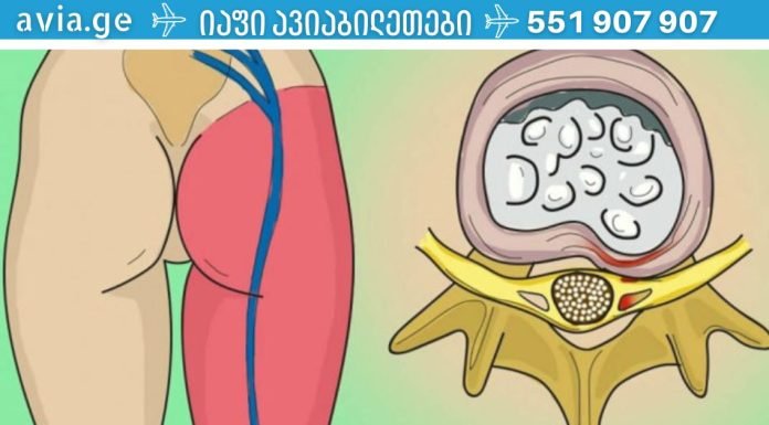 არსებობს 1 ვარჯიში, რომელიც ნამდვილად ხსნის წელის ტკივილს