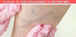 ხელნაკეთი მალამო ვარიკოზული ვენებისთვის, რომელმაც დედაჩემი გადაარჩინა ოპერაციისგან