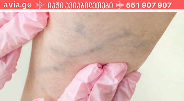 ხელნაკეთი მალამო ვარიკოზული ვენებისთვის, რომელმაც დედაჩემი გადაარჩინა ოპერაციისგან