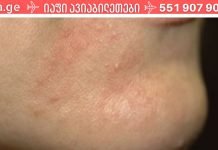 ხალხური საშუალებები, რომელებიც დაგეხმარებათ დერმატიტის განკურნებაში