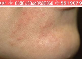 ხალხური საშუალებები, რომელებიც დაგეხმარებათ დერმატიტის განკურნებაში