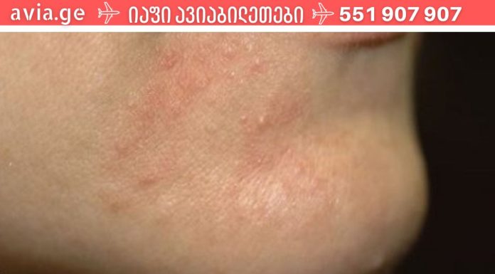 ხალხური საშუალებები, რომელებიც დაგეხმარებათ დერმატიტის განკურნებაში