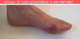 სასწაული საშუალებები პოდაგრის პროფილაქტიკისთვის