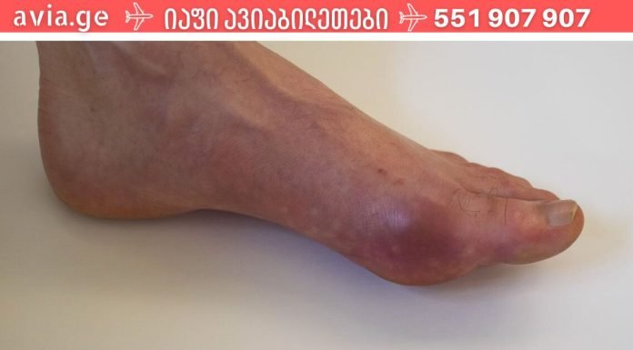 სასწაული საშუალებები პოდაგრის პროფილაქტიკისთვის