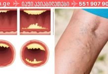 დაიცავით თავი ინფარქტისგან და იცხოვრეთ დიდხანს: აი, რა საკვები წმენდს თქვენს არტერიებს