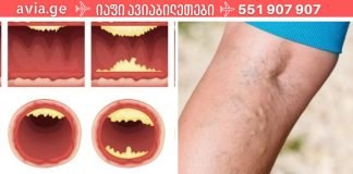 დაიცავით თავი ინფარქტისგან და იცხოვრეთ დიდხანს: აი, რა საკვები წმენდს თქვენს არტერიებს