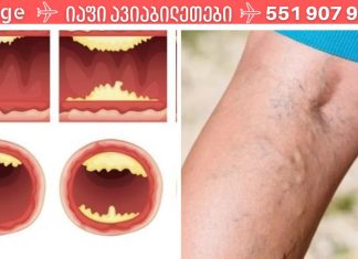 დაიცავით თავი ინფარქტისგან და იცხოვრეთ დიდხანს: აი, რა საკვები წმენდს თქვენს არტერიებს