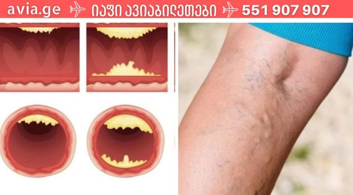 დაიცავით თავი ინფარქტისგან და იცხოვრეთ დიდხანს: აი, რა საკვები წმენდს თქვენს არტერიებს