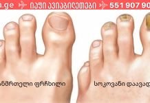 ფრჩხილის სოკოს 3 ხალხური საშუალება