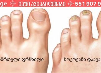 ფრჩხილის სოკოს 3 ხალხური საშუალება