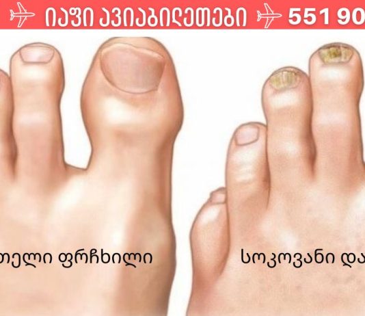 ფრჩხილის სოკოს 3 ხალხური საშუალება