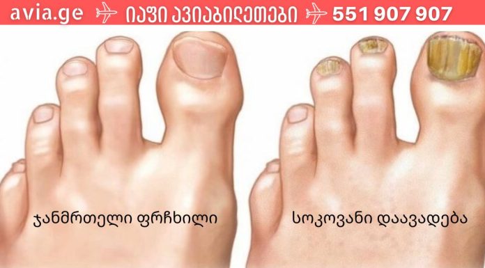 ფრჩხილის სოკოს 3 ხალხური საშუალება