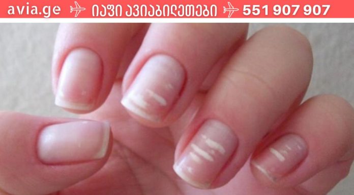 ფრთხილად იყავით.რატომ უჩნდება ზოგს თეთრი ლაქები ფრჩხილებზე?