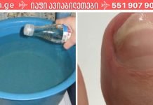 ჩემმა მეგობარმა უმარტივესად იმკურნალა სახლში ფრჩხილის სოკოზე.ეს სასწაულებრივი ნაზავი ერთხელ და სამუდამოდ აქრობს ფრჩხილის სოკოს.