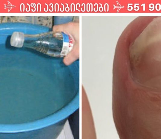 ჩემმა მეგობარმა უმარტივესად იმკურნალა სახლში ფრჩხილის სოკოზე.ეს სასწაულებრივი ნაზავი ერთხელ და სამუდამოდ აქრობს ფრჩხილის სოკოს.