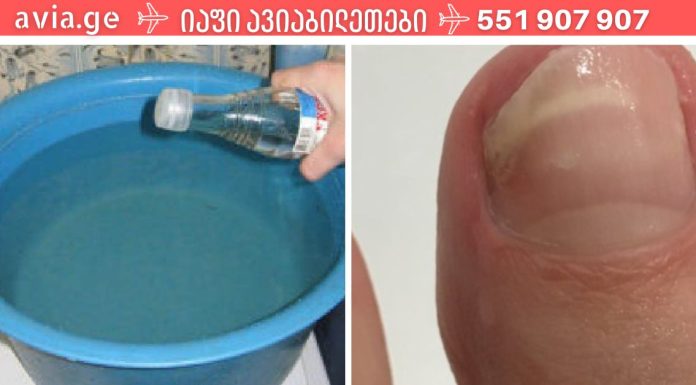 ჩემმა მეგობარმა უმარტივესად იმკურნალა სახლში ფრჩხილის სოკოზე.ეს სასწაულებრივი ნაზავი ერთხელ და სამუდამოდ აქრობს ფრჩხილის სოკოს.