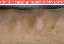 როგორ მოვიშოროთ ცხიმოვანი ქსოვილი (ლიპომა) ერთი ხალხური საშუალებით!?