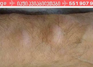 როგორ მოვიშოროთ ცხიმოვანი ქსოვილი (ლიპომა) ერთი ხალხური საშუალებით!?