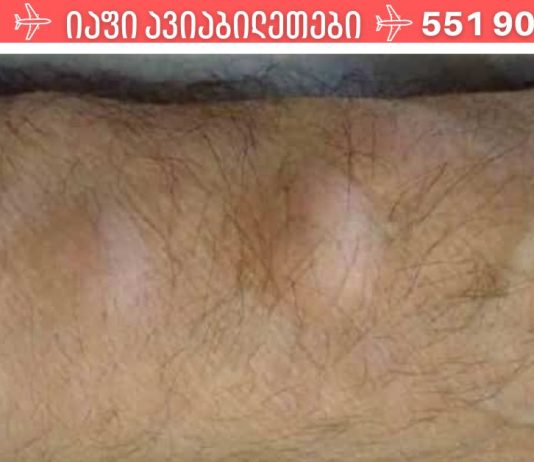 როგორ მოვიშოროთ ცხიმოვანი ქსოვილი (ლიპომა) ერთი ხალხური საშუალებით!?