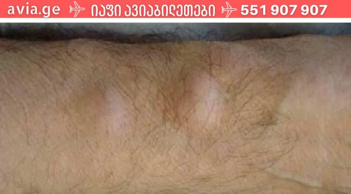 როგორ მოვიშოროთ ცხიმოვანი ქსოვილი (ლიპომა) ერთი ხალხური საშუალებით!?