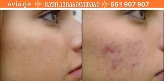 აკნეს ( პროჩიკების ) ყველაზე ეფექტური საშუალება!