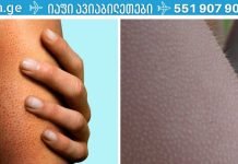 ფოლიკულური ჰიპერკერატოზი: როგორ მოვიშოროთ პატარა მუწუკები სხეულზე