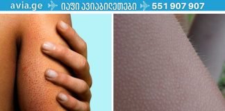 ფოლიკულური ჰიპერკერატოზი: როგორ მოვიშოროთ პატარა მუწუკები სხეულზე