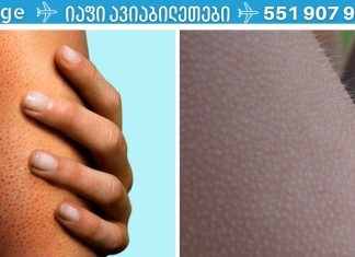 ფოლიკულური ჰიპერკერატოზი: როგორ მოვიშოროთ პატარა მუწუკები სხეულზე