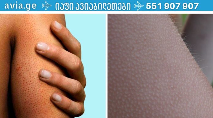 ფოლიკულური ჰიპერკერატოზი: როგორ მოვიშოროთ პატარა მუწუკები სხეულზე