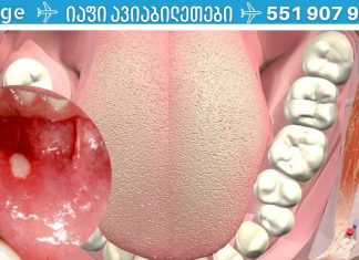 პირის ღრუს 6 პრობლემა, რომელებსაც ყურადღება უნდა მიაქციოთ,რადგან შეიძლება სხვა დაავადების გამოვლინება იყოს.