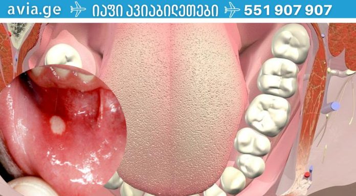 პირის ღრუს 6 პრობლემა, რომელებსაც ყურადღება უნდა მიაქციოთ,რადგან შეიძლება სხვა დაავადების გამოვლინება იყოს.