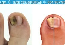 როგორ მოვიშოროთ ფრჩხილის სოკო იაფად და სწრაფად