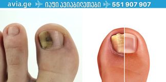 როგორ მოვიშოროთ ფრჩხილის სოკო იაფად და სწრაფად