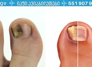 როგორ მოვიშოროთ ფრჩხილის სოკო იაფად და სწრაფად