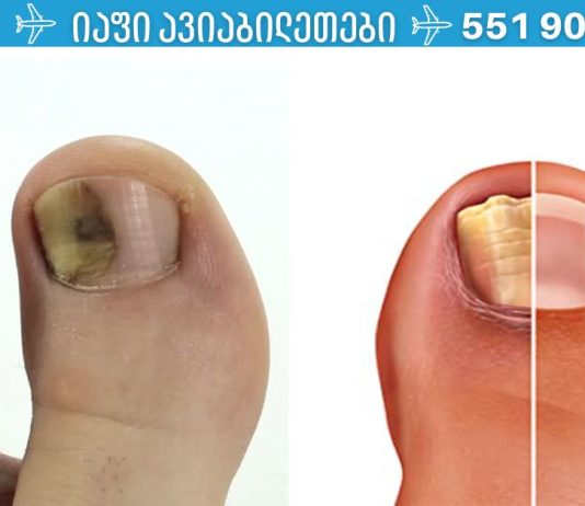 როგორ მოვიშოროთ ფრჩხილის სოკო იაფად და სწრაფად