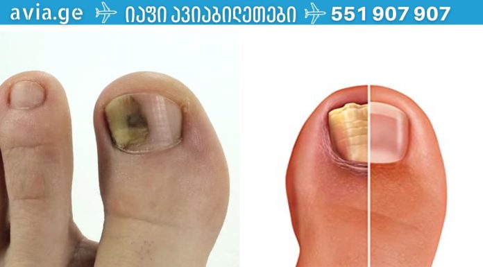 როგორ მოვიშოროთ ფრჩხილის სოკო იაფად და სწრაფად