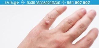 მეჭეჭებისგან თავის დაღწევის საუკეთესო გზები