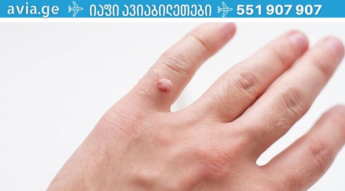 მეჭეჭებისგან თავის დაღწევის საუკეთესო გზები