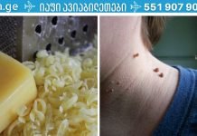 ნახეთ,როგორ მოვიშოროთ მეჭეჭები სარეცხი საპონით.