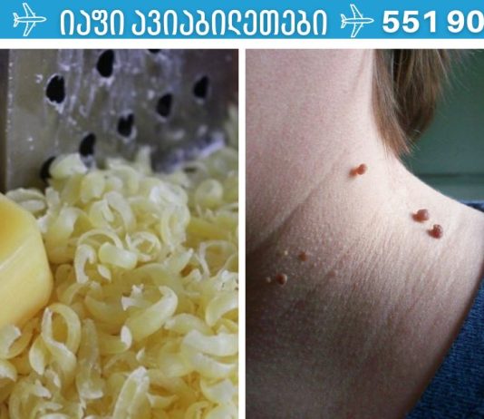 ნახეთ,როგორ მოვიშოროთ მეჭეჭები სარეცხი საპონით.