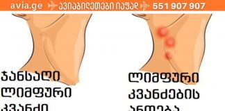 ლიმფური კვანძები და რა უნდა იცოდეთ მათზე