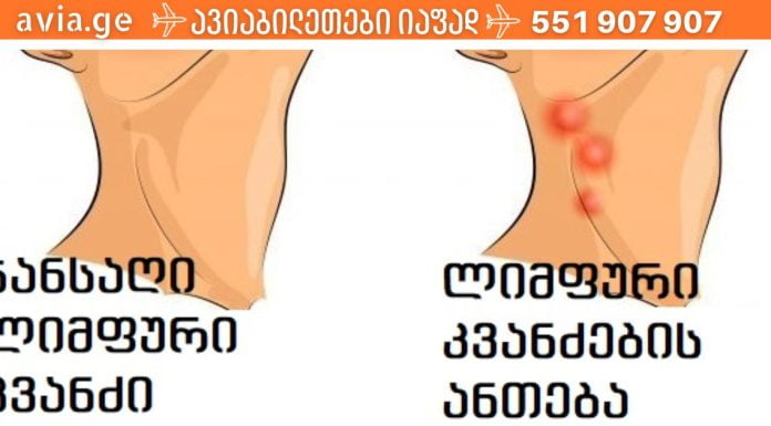 ლიმფური კვანძები და რა უნდა იცოდეთ მათზე