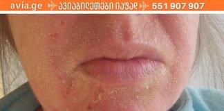 ცივი სეზონის პრობლემა – სებორეული დერმატიტი: პრაქტიკული ტრიქოლოგის რჩევები