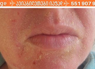 ცივი სეზონის პრობლემა – სებორეული დერმატიტი: პრაქტიკული ტრიქოლოგის რჩევები