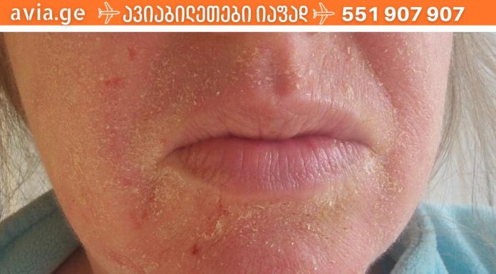 ცივი სეზონის პრობლემა – სებორეული დერმატიტი: პრაქტიკული ტრიქოლოგის  რჩევები