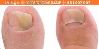 როგორ მოვიშოროთ ფრჩხილის სოკო იაფად და სწრაფად