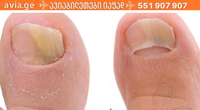 როგორ მოვიშოროთ ფრჩხილის სოკო იაფად და სწრაფად