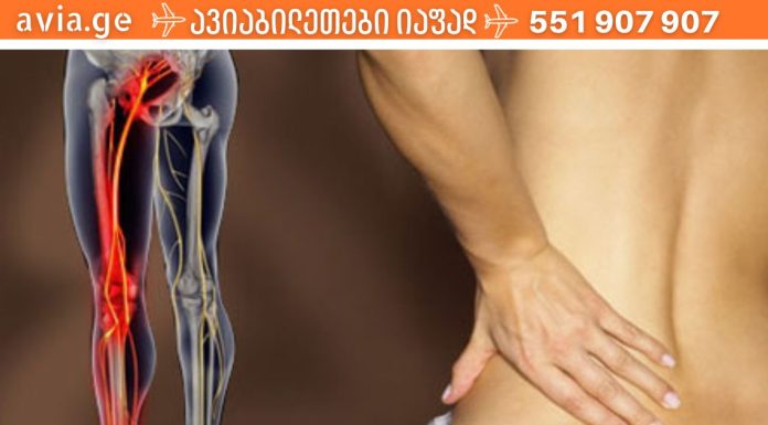 6 მარტივი გზა საჯდომის ნერვის (რადიკულიტის) ტკივილისგან თავის დასაღწევად