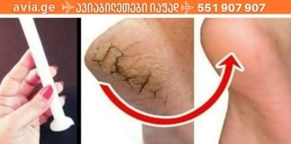 როგორ მოვიშოროთ დაბზარული ქუსლები