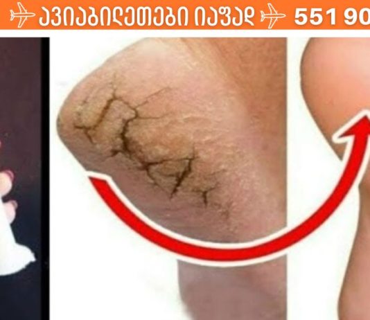 როგორ მოვიშოროთ დაბზარული ქუსლები